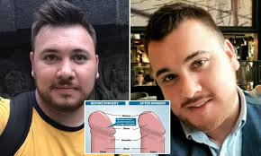 Man Cured Of Penile Papules After 30 Years Of Mistaking Them For Sti Daily Mail Online From singapore to the philippines to korea, aesthetics hub covers a. man cured of penile papules after 30
