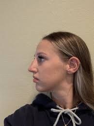 Perfect–my quality of breathing has been enhanced ten fold