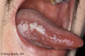 You can make a mouthwash with a witch hazel solution very easily at home to get rid of white bumps and spots from your tongue. Leukoplakia American Osteopathic College Of Dermatology Aocd