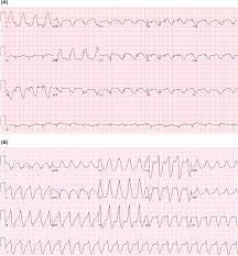 Fever, fatigue, myalgia, nausea and vomiting. Virus Myocarditis An Overview Sciencedirect Topics