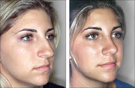 Pin On Plastic Surgery
