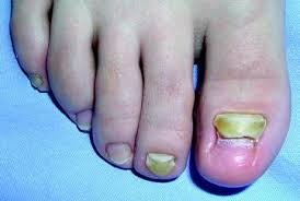 Image result for Pitting nails feet