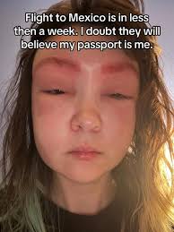 Allergic Reaction to Beard Dye