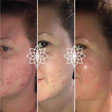Methode wangen gesicht anzahl der sitzungen; Dermaroller Vorher Nachher Bilder Faces Of Fey