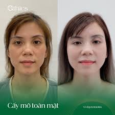 Cấy mỡ tự thân