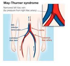 What Is Iliac Vein Compression Syndrome Dfw Heartplace Fibroids Venous Insufficiency Fibroid Surgery