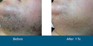 Laser hair removal targets pigment within the hair follicles and has best access to follicles when hair is in its growth phase. Laser Hair Removal Southgate Mi Attalla Aesthetics Southgate Mi