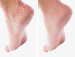 Pour Que Les Talons Soient Toujours Lisses Fais Des Bains De Pieds Pour Deux Tasses D Eau Tiede Util Astuces Beaute Secrets De Beaute Astuces Beaute Visage