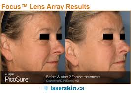 25% OFF Laser Skin Resurfacing with PicoSure
