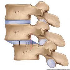 Tennis elbow is a condition caused by inflammation of the tendons on the outside of the elbow at a bony prominence (lateral epicondyle) of the upper arm. Duncraig Physiotherapy Clinic Perth Duncraig Physio Clinic Duncraig Physiotherapy