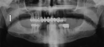 Use of the mladick's technique, and, after the first few postoperativedays,theindividualcanbefollowedonan outpatient basis. Intraoperative Imaging Techniques A Guide To Retrieval Of Foreign Bodies Oral Surgery Oral Medicine Oral Pathology Oral Radiology And Endodontics