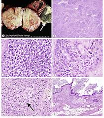 Malignant tumor ae med. das malignom pl.: Malignant Brenner Tumor Associated With Mature Cystic Teratoma A On Download Scientific Diagram