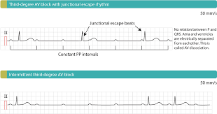 This is known as an escape rhythm. Third Degree Av Block 3rd Degree Av Block Av Block 3 Av Block Iii Ecg Echo