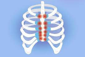 The middle and upper part of your spine is called the thoracic region and it helps to support your upper body. Costochondritis And Arthritis Understanding Symptoms And Treatment