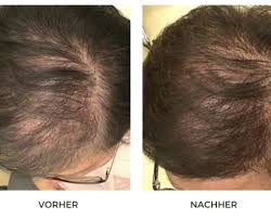 You're under physical or emotional stress. Dr Cyj Hair Filler Prp For Hair Loss Costs Procedure Hamburg