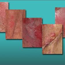 They are caused by an overgrowth of a fungus called candida. Chronic Vulvar Symptoms And Dermatologic Disruptions How To Make The Correct Diagnosis Mdedge Obgyn