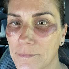 Say goodbye to tired eyes and hello to a refreshed, youthful glow! ✨ Our  talented aesthetician @fullspecialist_farrah worked her magic with an  under-eye chemical peel, transforming dull, tired skin into bright,  rejuvenated