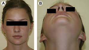 Improving Esthetic Results in Benign Parotid Surgery: Statistical  Evaluation of Facelift Approach, Sternocleidomastoid Flap, and