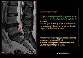 Pin By Veljko Maksic On Columna Vertebral Mri Brain Radiology Neuro