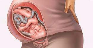 gebelikte plasenta previa nedir durumu nasil olmalidir obezite haber