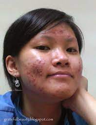 Jangan membuat masalah bertambah parah. My Acne Story Perjuangan Melawan Jerawat Kornelia Luciana
