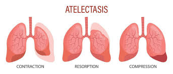 Image result for Atelectasis