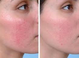 Naturliche Behandlung Von Rosacea Hautkrankheiten Rotes Gesicht Heilmittel
