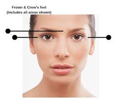 After watching this video it is expected that you will be able to discuss the anatomy of wrinkle lines in the face in relation to the muscles involved, preferred sites of injections, and possible complications: Botox Pricing Guide Top 4 Areas Of Face Number Of Units Required