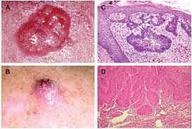 People who have an extreme sensitivity to sunlight are born with a rare disease known as xeroderma pigmentosum (xp). Full Text Clinical Features Related To Xeroderma Pigmentosum In A Brazilian Pati Tacg