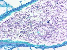 Chronic pulmonary aspergillosis (cpa) is an uncommon and problematic pulmonary disease, complicating many other respiratory disorders, thought to affect ∼240 000 people in europe. Fungus Pas Aspergillus Sp Histology Control Slides Artificial