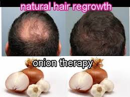 Onions contain sulphuric compounds that have proven to have great results on hair. Can Onion And Garlic Juice Be Mixed Together To Regrow Hair On Bald Patches Quora