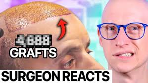 HAIR TRANSPLANT in TURKEY