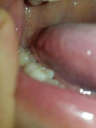 Diet and nutrition ideas · natural remedies · latest health trends Bumps On Right Side Of My Tongue Left Side Is Smoother Cause For Concern Oral Cancer Redditmd