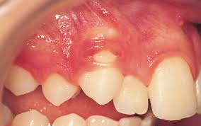 This facilitates eruption and orthodontic traction. 3 Surgical Exposure Of Impacted Teeth Pocket Dentistry
