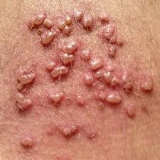 Ingrown hairs often arise after trying to remove hair, whether by shaving, tweezing, or plucking. How To Tell The Difference Between Herpes And Pimples With Photos Youmemindbody