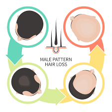 While it is probably the most natural ingredient found in commercial hair products, it is still cause for concern when it comes to hair loss. Hair Loss Harvard Health