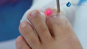 Jun 04, 2021 · los hongos en los pies, conocidos popularmente como pie de atleta y médicamente como tinea pedis, es una infección fúngica de la piel que produce sarpullidos escamosos. Hongos En Las Unas De Pies Y Manos Causas Y Tratamientos