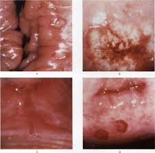 Image result for genital herpes