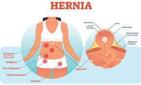 Inguinal herniation was the initial sign of cancer in six patients. Understanding The 5 Common Types Of Hernia Health Plus