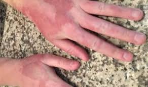 Image result for Photodermatitis