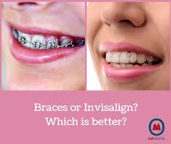 It can take some getting used to the way braces look, and many people feel self conscious, especially when they first get braces. Understanding The Difference Between Braces And Invisalign