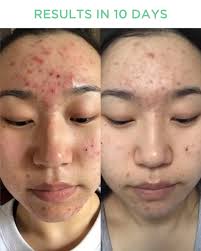 Oily/Combination/Breakouts Bundle (Save 30%)