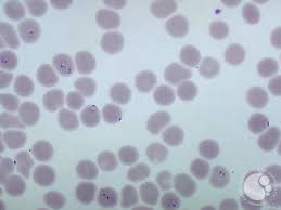 The word malaria with the assorted pills and capsules on white background. Severe Malaria Blood Smear