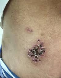 Image result for herpes zoster