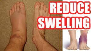 How To Reduce Swelling: Make Your Swelling Go Down Easy Methods - Youtube