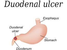 Home Remedies For Duodenitis Can Include Usage Of Banana Honey Carrot Juice Raw Cabbage Food Containing High Fibre Such As Ulcers Home Remedies Ulcer Diet