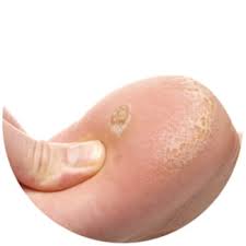 Com ingredientes fáceis de encontrar ou que você tenha na sua cozinha. Verruga Plantar Causas E Tratamento Ccm Saude