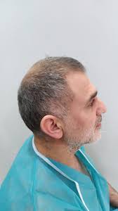 2026 Turkey Hair Transplant Reviews