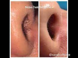 One uses heat developed by light to remove hair (lasers) and the other uses heat developed by electricity (electrolysis) to remove hair. Ways To Remove Nose Hair By Ipl Or Laser Youtube