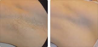 I have pale skin and dark brown hair (pretty much a snow white type) so i believe i might be a good candidate (the lady asked me to come unshaved for the first session so she can look at my hair and determine if the laser is a good fit for my skin and hair. Laser Hair Removal Hayes Valley Medical Esthetics